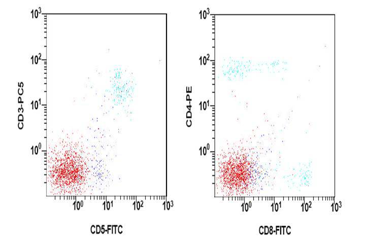 Flow cytometry of bone marrow at the time of leukemic presentation-additional markers